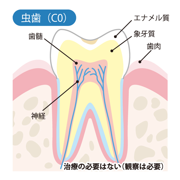 守谷（茨城県守谷市）の歯医者、医療法人社団SMILELAND河合歯科でむし歯治療