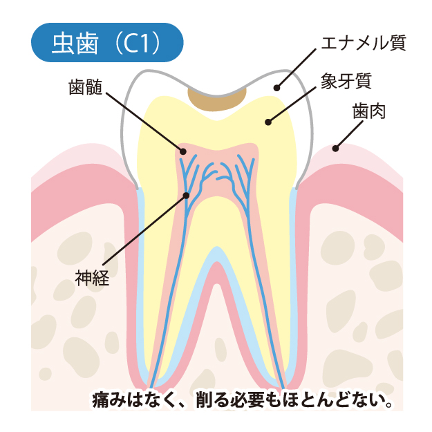 守谷（茨城県守谷市）の歯医者、医療法人社団SMILELAND河合歯科でむし歯治療