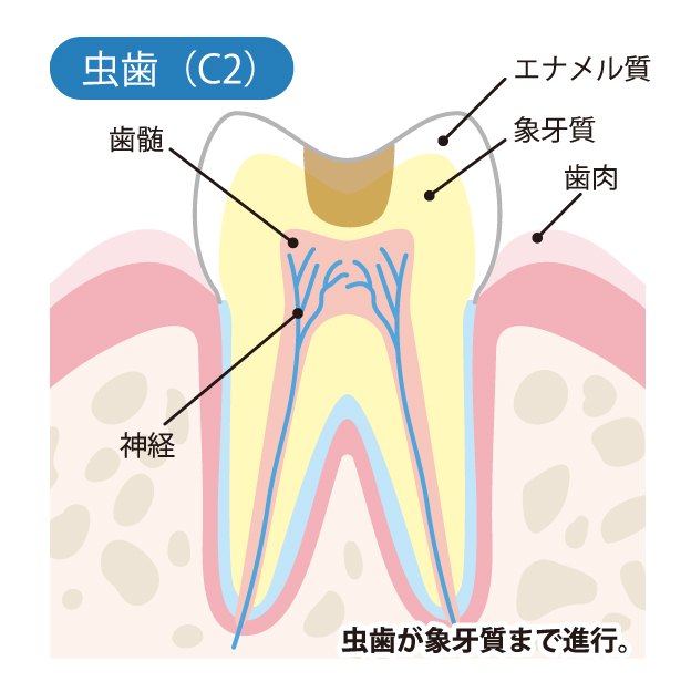 守谷（茨城県守谷市）の歯医者、医療法人社団SMILELAND河合歯科でむし歯治療