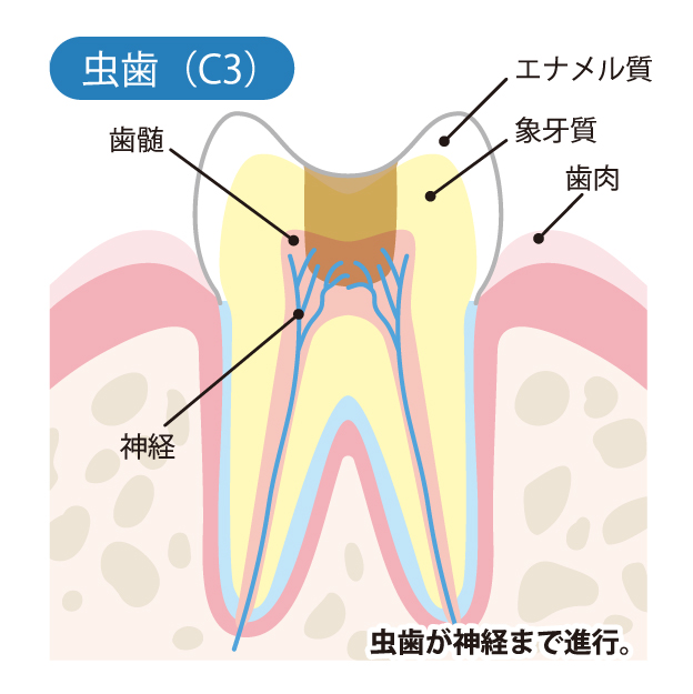 守谷（茨城県守谷市）の歯医者、医療法人社団SMILELAND河合歯科でむし歯治療