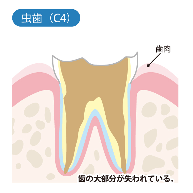 守谷（茨城県守谷市）の歯医者、医療法人社団SMILELAND河合歯科でむし歯治療